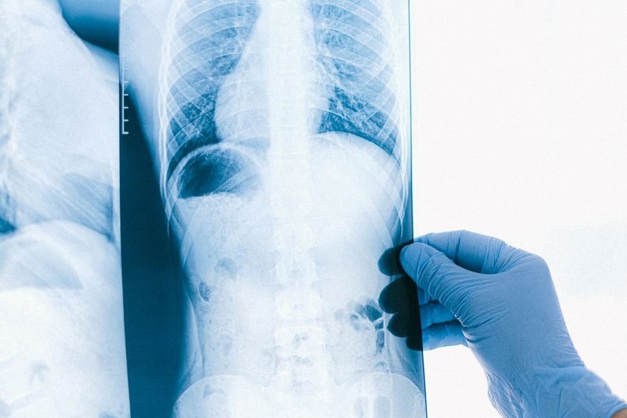 Interstitial Lung Disease — interstitial lung disease treatment in Rewari